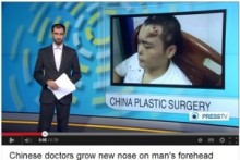 【アジア発！Breaking News】22歳男性の額に「鼻」を作った形成外科医、その意図には疑問も。（中国）