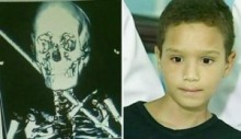 【南米発！Breaking News】首に鉄の棒が貫通した10歳少年、奇跡的に無事。（ブラジル）