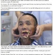 【アジア発！Breaking News】オオカミに咬まれて口元が変形した中国人男性、ついに形成外科手術へ。＜画像閲覧注意＞