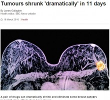 【海外発！Breaking News】腫瘍が11日間で消滅も　画期的乳がん治療発見か「抗HER2薬」（英）