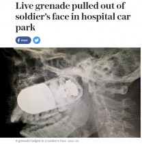 【海外発！Breaking News】榴弾が顔に！　病院駐車場で手術が行われる（コロンビア）