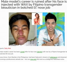 【海外発！Breaking News】鼻と顎の美容整形に大失敗　イケメンモデルのキャリアが台無しに（フィリピン）