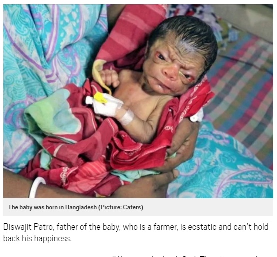 バングラデシュで男の赤ちゃんが早老症を伴って誕生（出典：http://metro.co.uk）