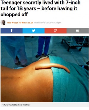 【海外発！Breaking News】「ラッキーチャーム」と信じ17.8センチの尻尾を隠し持っていた18歳の男性　手術で無事切除（印）