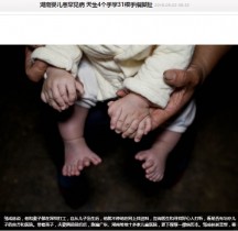 【海外発！Breaking News】手足に31本「多指症」の赤ちゃん、手術完了は3歳（中国）