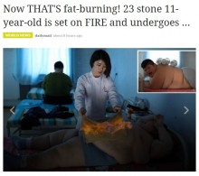 【海外発！Breaking News】肥満の腹部の上に炎を放つ　中国の新痩身術が恐ろしすぎる