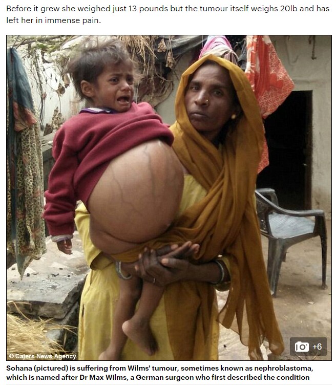 腫瘍のせいで妊婦のようなお腹を持つ2歳児（出典：http://www.dailymail.co.uk）