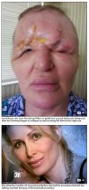 【海外発！Breaking News】「まるでエイリアンだった」　美容整形手術で顔面が膨張　片目を失明した54歳女性の悲劇（米）