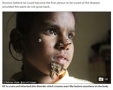 顔から木の根が生えたよう　「ツリーマン病」に悩まされる10歳の少女（バングラデシュ）