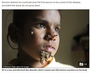 【海外発！Breaking News】顔から木の根が生えたよう　「ツリーマン病」に悩まされる10歳の少女（バングラデシュ）