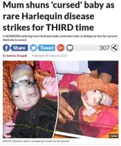 【海外発！Breaking News】奇病・ハーレクイン型魚鱗癬の赤ちゃん誕生も人々は「ヒンドゥーの神の化身」（印）