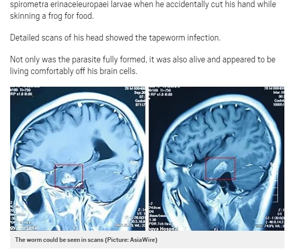 19歳男性の脳にマンソン裂頭条虫が寄生（出典：http://metro.co.uk）