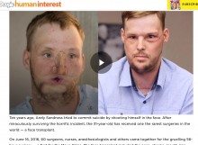 【海外発！Breaking News】ライフル銃自殺で顔半分が崩壊の男性、10年を経て顔面移植を受ける（米）