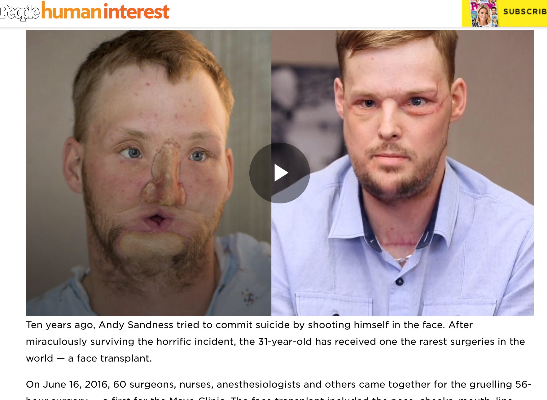 顔面移植に成功した男性（出典：http://people.com）