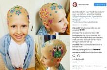 【海外発！Breaking News】脱毛症の7歳少女、素敵な方法で「クレイジーヘア・デー」に参加（米）