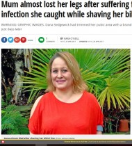 【海外発！Breaking News】ビキニラインの脱毛処理をした女性、感染症で命の危機に（英）