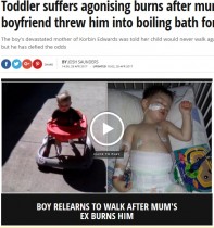 【海外発！Breaking News】「ズボンを汚したから」と熱湯の浴槽へ　3度熱傷から奇跡の回復を見せた男児（米）