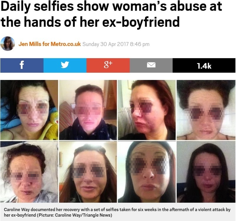 元カレに受けたDVの傷を自撮りして公開した女性（出典：http://metro.co.uk　画像を一部加工しています）