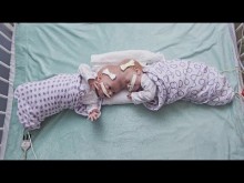 【海外発！Breaking News】頭部が結合して生まれた双子、生後10か月目で分離手術を受ける（米）