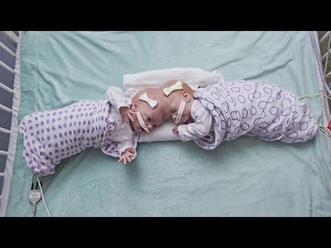 頭蓋結合体双生児の女の子（画像は『Inside Edition 2017年6月13日公開 YouTube「10-Month-Old Twins Joined at the Head Successfully Separated」』のサムネイル）