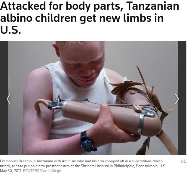 腕を奪われたアルビノ少年、新しい義手をつける（画像は『REUTERS　2017年5月30日付「Attacked for body parts, Tanzanian albino children get new limbs in U.S.」（REUTERS/Carlo Allegri）』のスクリーンショット）