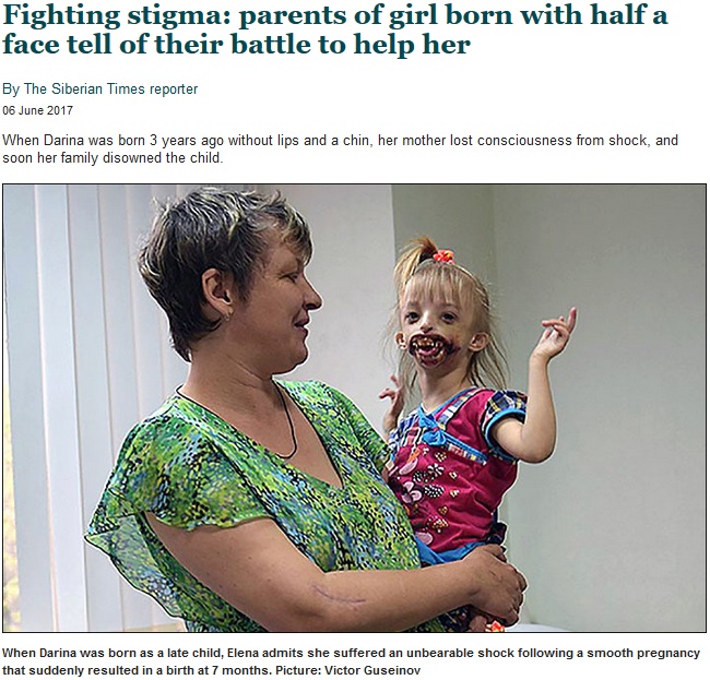 親族から拒絶された3歳女児（画像は『Siberian Times　2017年6月6日付「Fighting stigma: parents of girl born with half a face tell of their battle to help her」（Picture: Victor Guseinov）』のスクリーンショット）