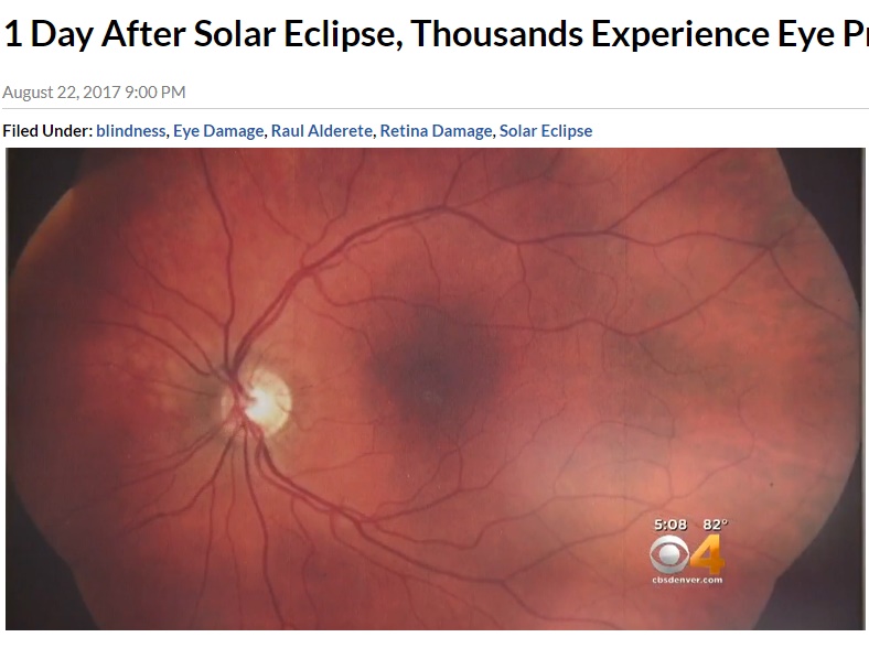 皆既日食を楽しんだ人々、続々と眼科医を受診（画像は『CBS Denver　2017年8月22日付 「1 Day After Solar Eclipse, Thousands Experience Eye Problems」』のスクリーンショット）