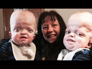 【海外発！Breaking News】遺伝子異常の難病を抱える双子を養子にした58歳元看護師（米）＜動画あり＞