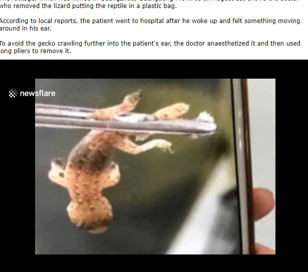中国で男性の耳からヤモリを摘出（画像は『LiveLeak　2017年8月19日付「Doctor removes live gecko from man's ear」（NewsFlare）』のスクリーンショット）