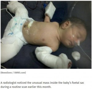 【海外発！Breaking News】誕生した男児のお腹に胎児が！　「胎児内胎児」の摘出手術が無事成功（印）