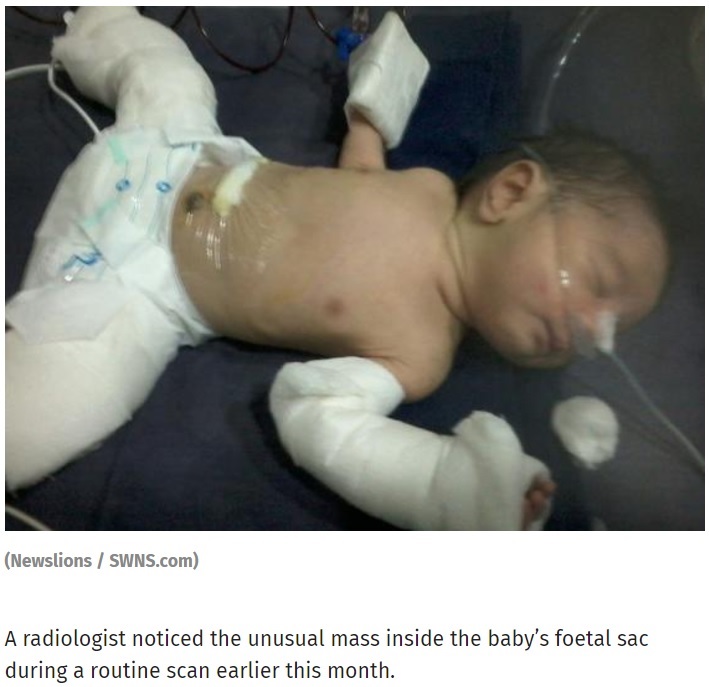 誕生した男児のお腹に胎児が！（画像は『The Independent　2017年8月1日付「BABY BORN ‘PREGNANT’WITH HALF-FORMED TWIN BROTHER BEHIND HIS STOMACH」（Newslions / SWNS.com）』のスクリーンショット）