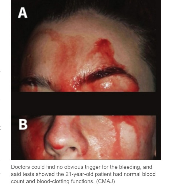 汗とともに血液が流れだす女性（画像は『CBC.ca　2017年10月23日付「Sweating blood: bizarre disorder baffles doctors」（CMAJ）』のスクリーンショット）