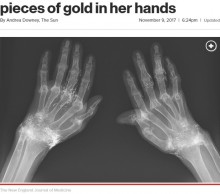 【海外発！Breaking News】鍼治療で両手に無数の金の針が埋め込まれていた女性（韓国）