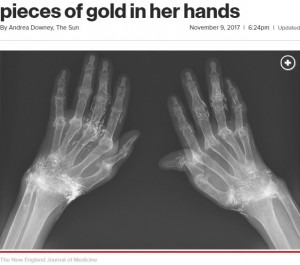 【海外発！Breaking News】鍼治療で両手に無数の金の針が埋め込まれていた女性（韓国）