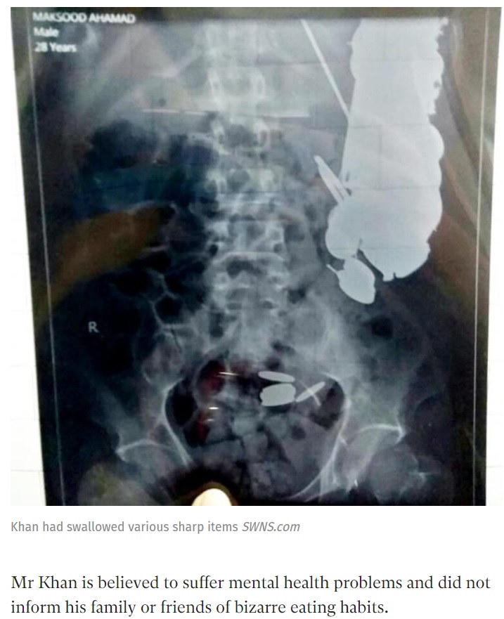 男性の腹部には大量の硬貨や釘が…（画像は『The Independent　2017年11月27日付「Surgeons operating on man for stomach bug shocked to find hundreds of coins and nails inside him」（SWNS.com）』のスクリーンショット）