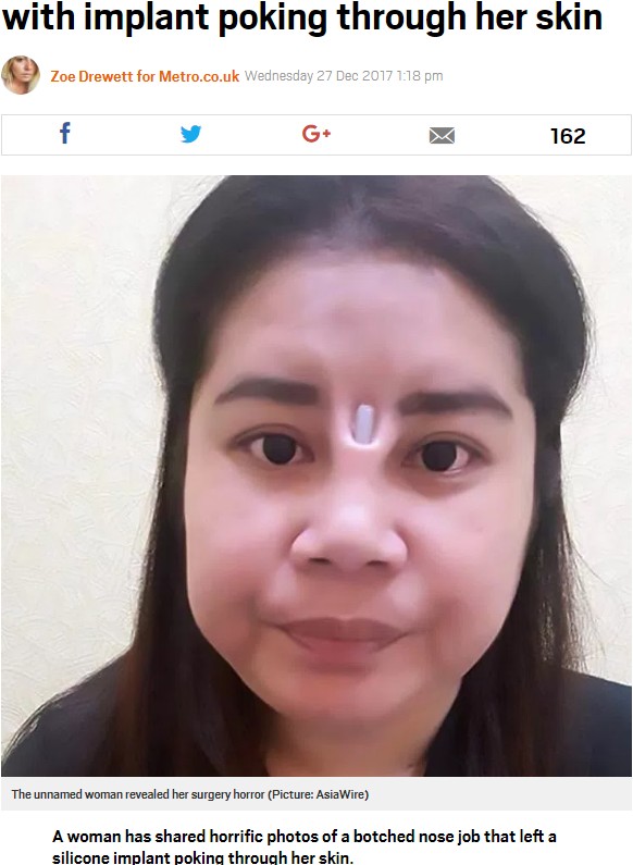 鼻からシリコンインプラントが飛び出てしまった女性（画像は『Metro　2017年12月27日付「Woman’s botched nose job left her with implant poking through her skin」（Picture: AsiaWire）』のスクリーンショット）