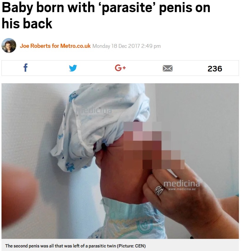 背中に陰茎を持った乳児（画像は『Metro　2017年12月18日付「Baby born with ‘parasite’ penis on his back」（Picture: CEN）』のスクリーンショット）