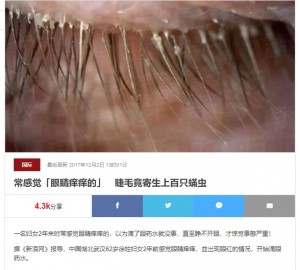 【海外発！Breaking News】不潔な枕カバー5年使用　開かない瞼の原因は100匹超のまつ毛ダニ（中国）