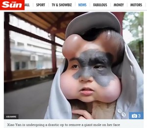 【海外発！Breaking News】顔の痣除去のため、顔面に医療用風船を埋め込んだ女性（中国）