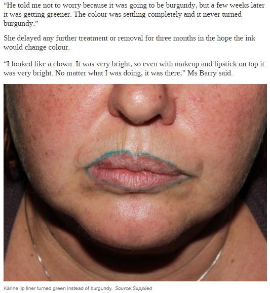 ずさんな豊唇タトゥーに泣いた豪女性（画像は『news.com.au　2018年1月27日付「Victorian woman’s nightmare after tattooed lip liner turned green」（Source：Supplied）』のスクリーンショット）