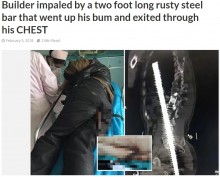 【海外発！Breaking News】錆びた鉄筋、尻から突き刺さり胸へ　建設作業員を救急搬送（中国）　