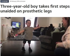 【海外発！Breaking News】脚を切断した3歳児　義足をつけて初めて歩く（英）＜動画あり＞