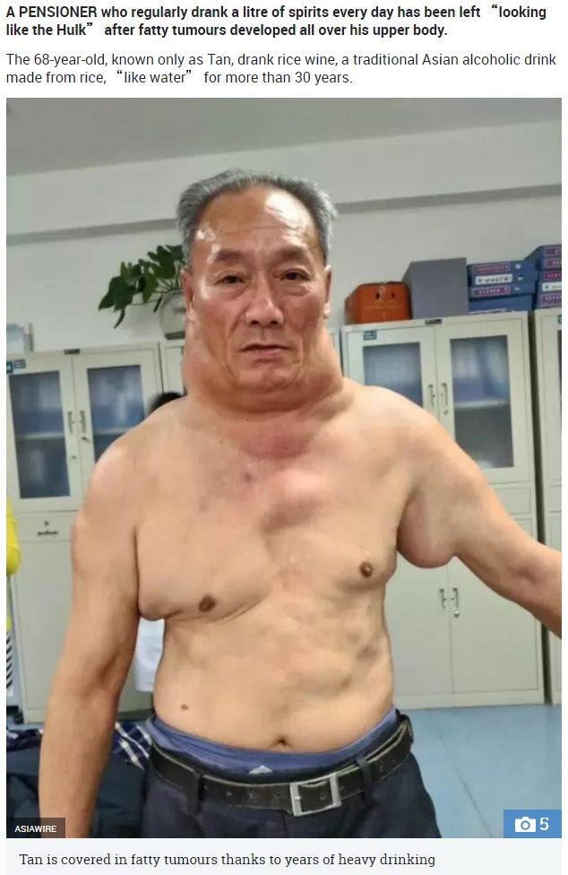 脂肪腫ができてしまった中国の男性（画像は『The Sun　2018年3月19日付「BOOZE BULGE Pensioner left ‘looking like the hulk’ after 30 YEARS of heavy drinking left him covered in fatty tumours」（IMAGE: ASIAWIRE）』のスクリーンショット）