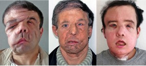【海外発！Breaking News】世界初、2回目の顔面移植手術を受けた男性　60代から20代の顔に（仏）