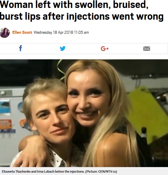 友人（左）にリップフィラーを施術してもらう前の女性（画像は『Metro　2018年4月18日付「Woman left with swollen, bruised, burst lips after injections went wrong」（Picture: CEN/NTV.ru）』のスクリーンショット）