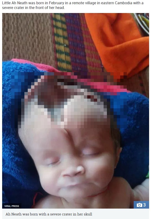 頭蓋骨欠損で生まれてきた乳児（画像は『The Sun　2018年4月9日付「MIRACLE TOT Baby girl born with half her skull MISSING defies the odds to survive」（IMAGE: VIRAL PRESS）』のスクリーンショット　　画像を一部加工しています）