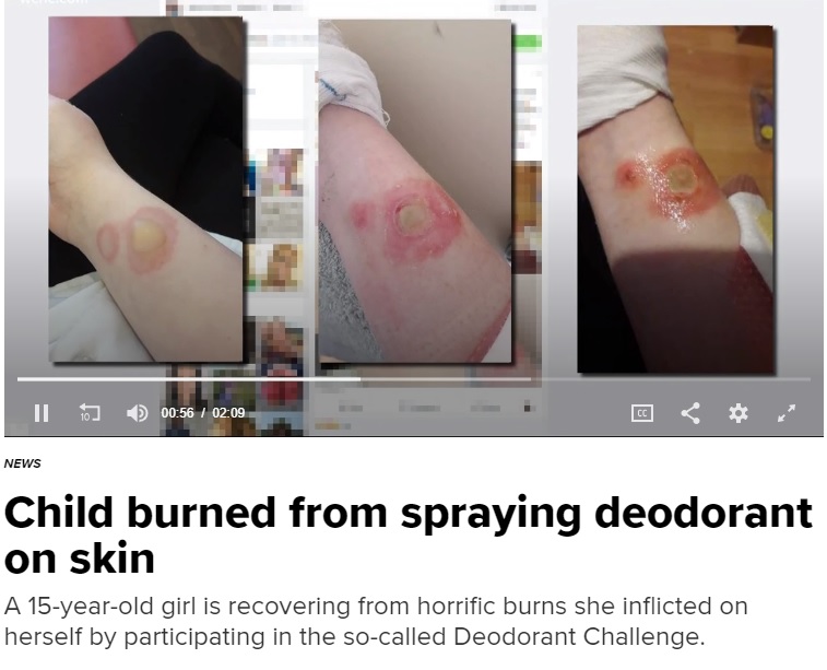 欧米の少年少女の間でまた危険なチャレンジが流行中（画像は『KHOU.com　2018年5月9日付「Child burned from spraying deodorant on skin」』のスクリーンショット）