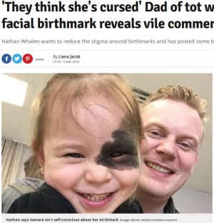 【海外発！Breaking News】顔に黒いあざを持って生まれた娘　心無い批判をする人に父が切実な訴え（カナダ）
