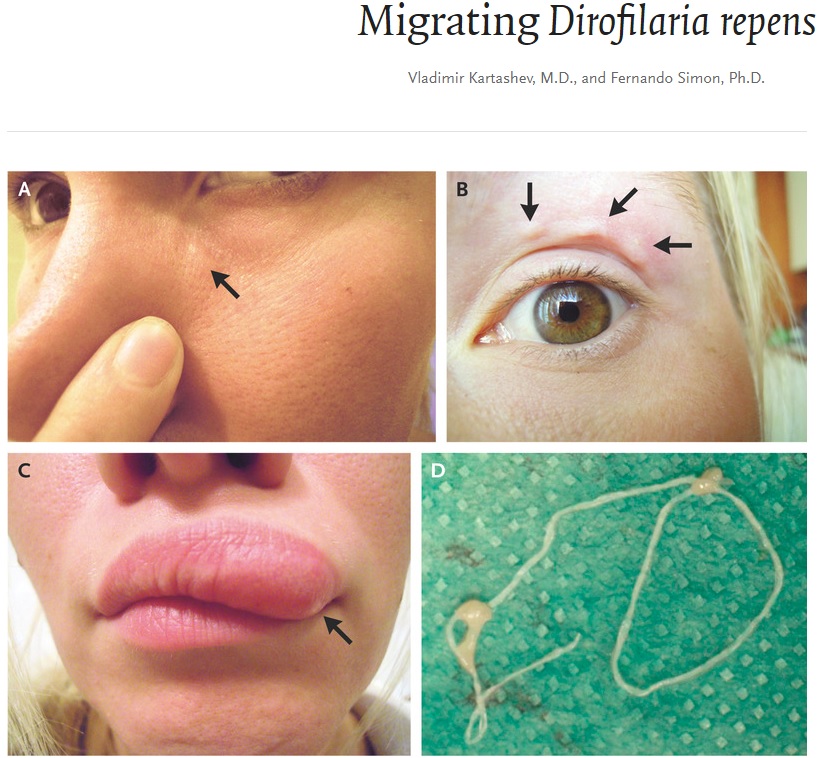 皮膚の腫れ物が移動する様子を記録した女性（画像は『The New England Journal of Medicine　2018年6月21日付「Migrating Dirofilaria repens」』のスクリーンショット）