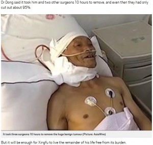 【海外発！Breaking News】47年間首に背負っていた15kgの腫瘍を摘出した男性（中国）